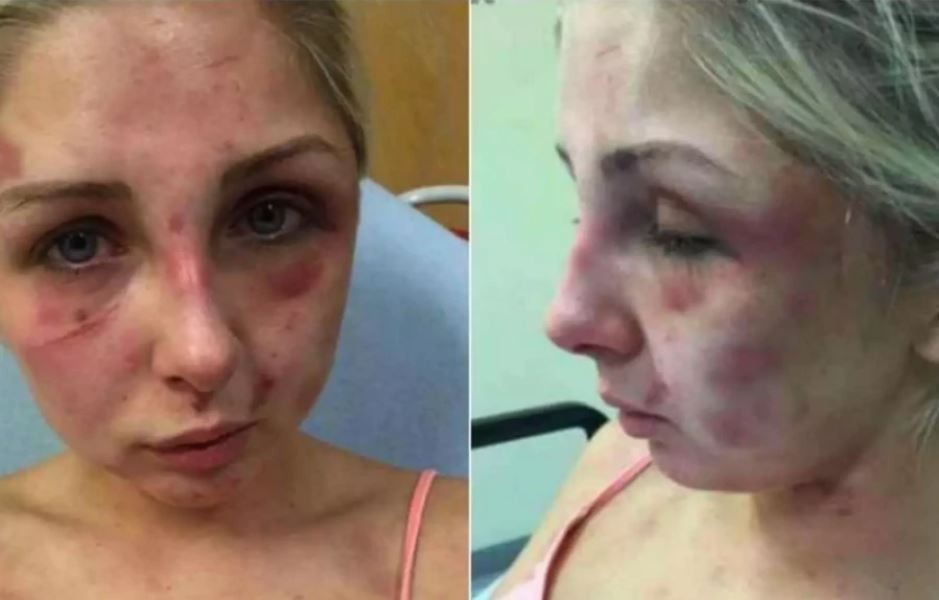 Момчето ја тепало четири часа, а не му било прв пат: 18-годишна девојка ја споделува голготата низ која минувала за да ја подигне свеста за насилство врз жените