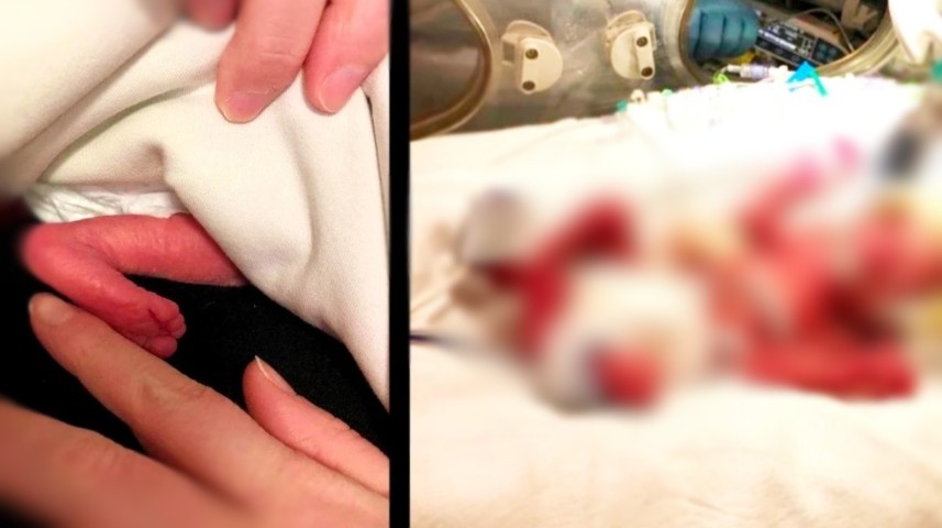 Се роди во 24-та недела, неговото стапало беше помало од прстот на мајка му: Но, погледнете како изгледа денес (ФОТО)