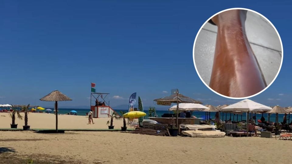 „Немам поим што се случи“: Низ смеа ја покажа морничавата кожа по летувањето, ова може да биде опасно по живот