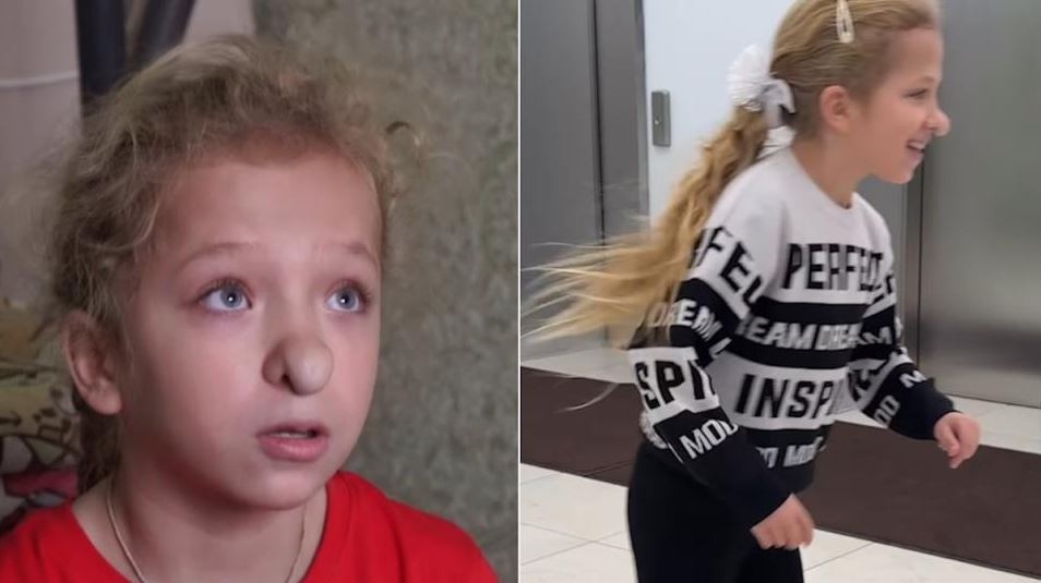 Се плаши да излезе надвор поради носот: Ја викаат „Баба Јага“, таа дури и не оди на училиште поради малтретирање