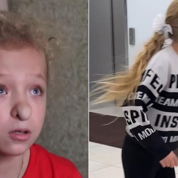 Се плаши да излезе надвор поради носот: Ја викаат „Баба Јага“, таа дури и не оди на училиште поради малтретирање